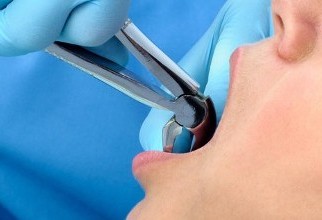 Viva-Dent Gabinety Stomatologiczne - Usuwanie zębów
